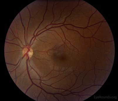 Toxic optic neuropathy. An optic nerve with temporal pallor due to alcohol and tobacco use.
